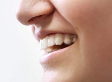 Aligner